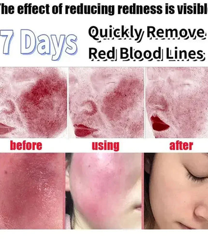 7 Day Repair Redness Serum Sooth Itching Sensitive Skin Improve